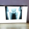 Negatoscopio visor radiografias